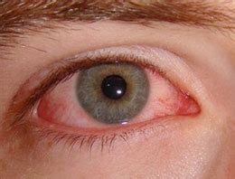 göz hastalığına bağlı hipertansiyon